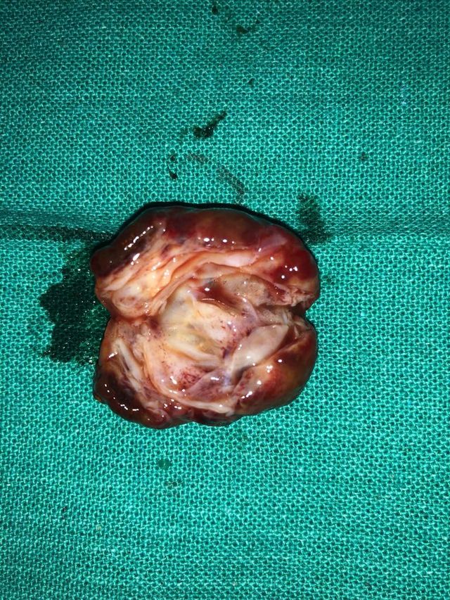 diagnosis of recurrent hydatid cyst