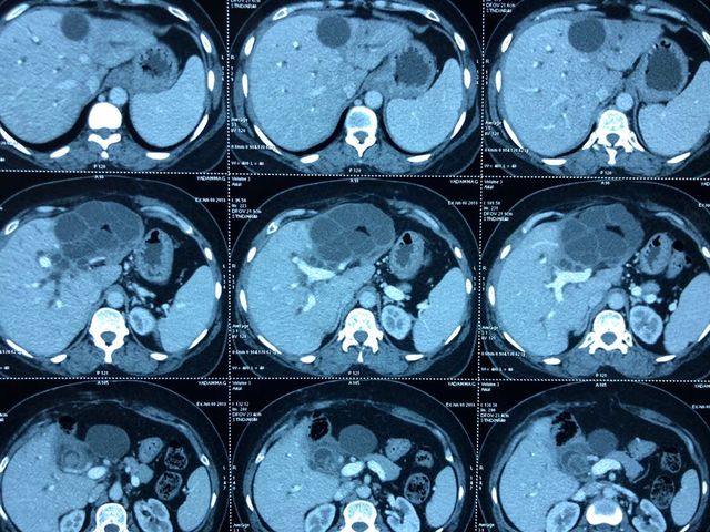 diagnosis of recurrent hydatid cyst