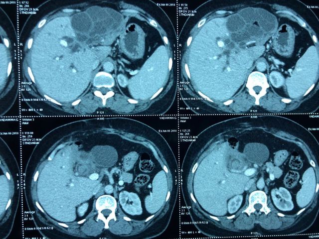 diagnosis of recurrent hydatid cyst