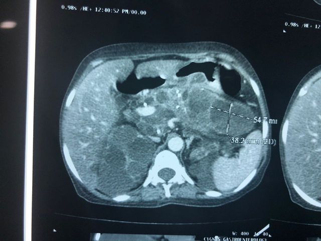 Total pancreaticoduodenectomy with splenectomy