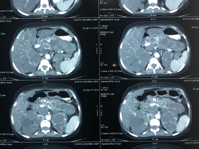 Total pancreaticoduodenectomy with splenectomy