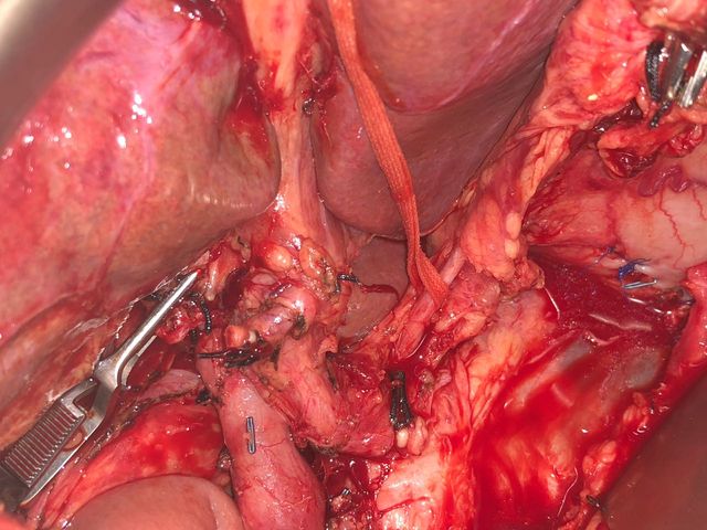 Total pancreaticoduodenectomy with splenectomy