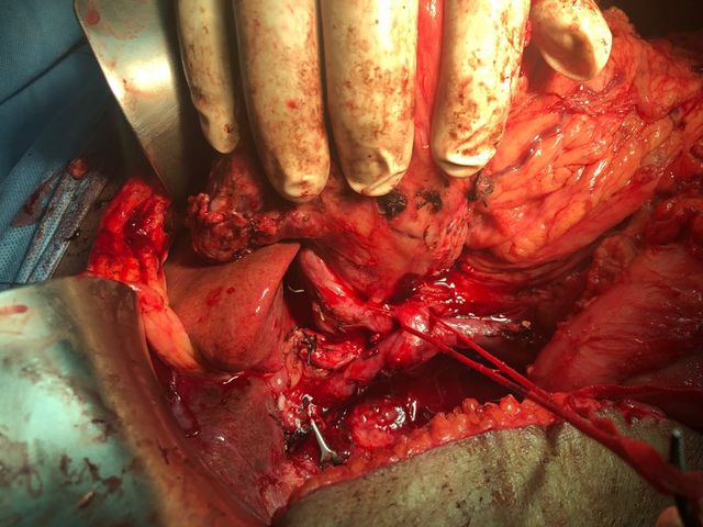 Total pancreaticoduodenectomy with splenectomy