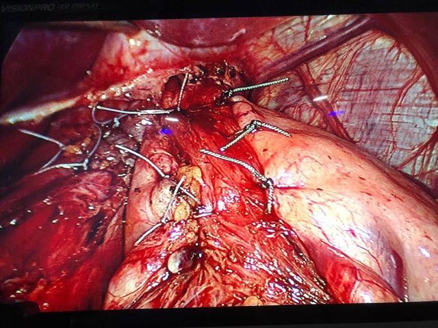 270 degree toupet fundoplication for GERD with hiatus hernia