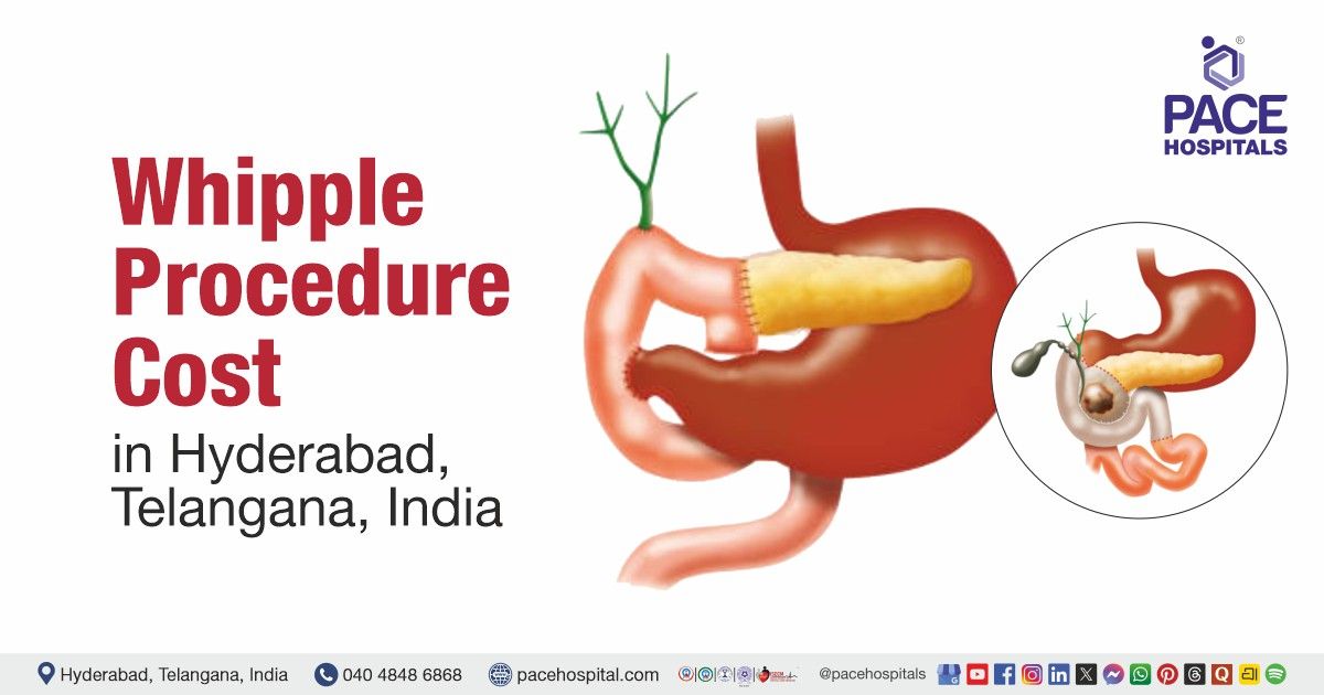 Cost of Whipple Procedure in Hyderabad, Whipple Procedure Cost estimate