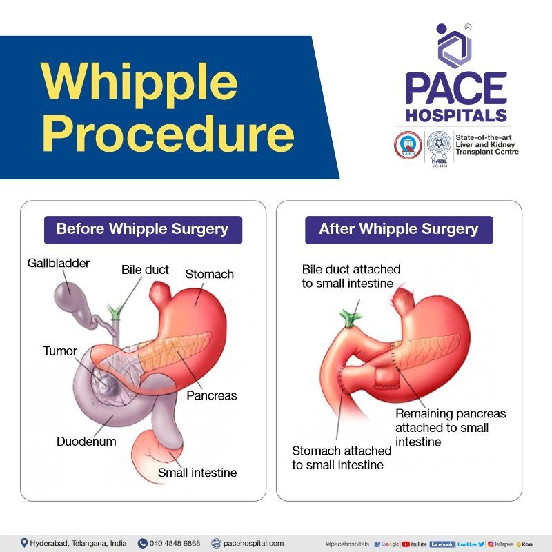 whipples procedure | whipple operation for pancreatic cancer | Whipple surgery in Hyderabad