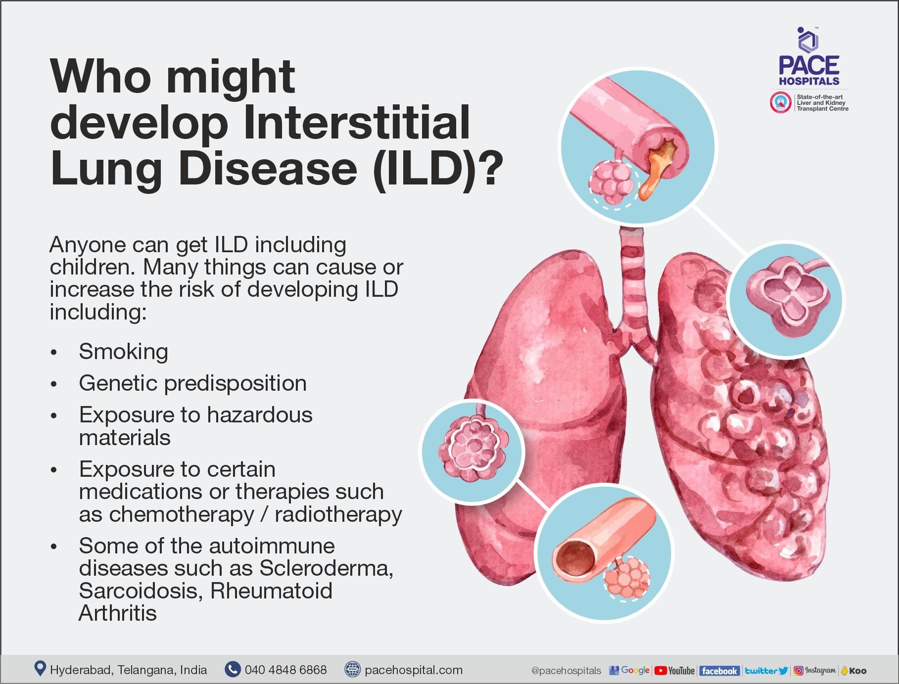 Who might develop Interstitial Lung Disease (ILD) - Causes and Risk Factors | Pace Hospitals