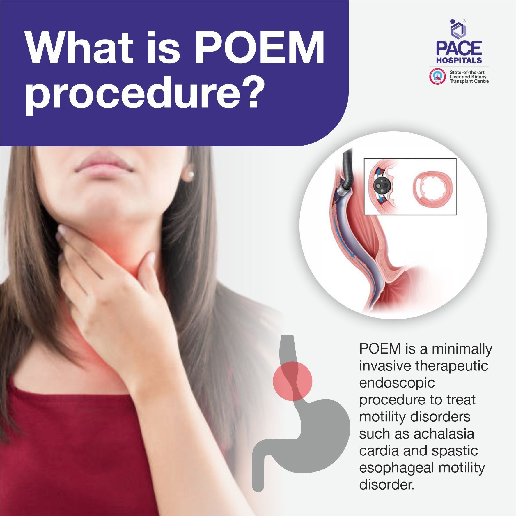 What is POEM for achalasia cardia