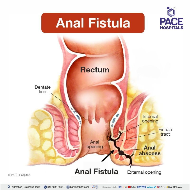 what is an anal fistula | fistula in ano, anal fistula meaning | anal fistula definition | fistula in ano images | anal fistula anatomy pictures