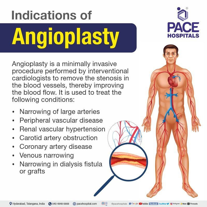 angioplasty indications | best hospital for angioplasty in hyderabad telangana | angioplasty surgery cost in hyderabad | angioplasty surgery famous in hyderabad