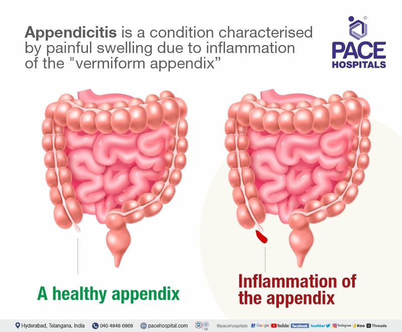 appendix meaning | appendicitis pain location | appendicitis meaning | appendicitis pain area