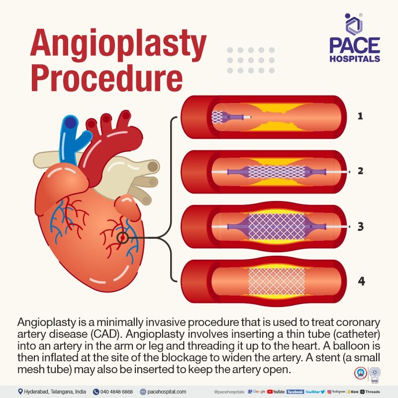 what is angioplasty procedure | best angioplasty hospitals in hyderabad near me | angioplasty cost hyderabad telangana india