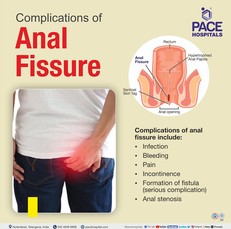 complications of anal fissure | anal fissures complication | chief complaints of anal fissure