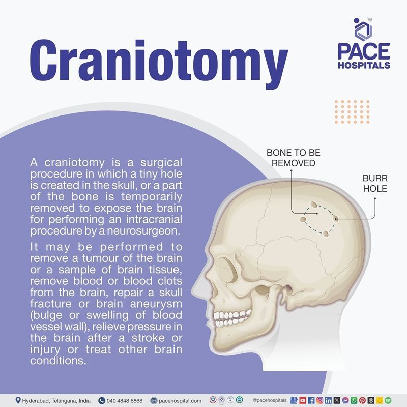 craniotomy surgery meaning | craniotomy procedure cost in Hyderabad, India | craniotomy definition | what is a craniotomy