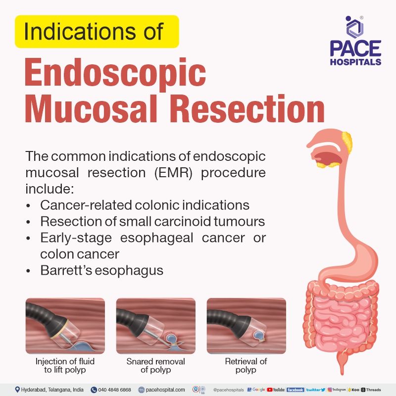 Indications for endoscopic mucosal resection procedure | Endoscopic Mucosal Resection procedure in Hyderabad | endoscopic mucosal resection colon polyps | endoscopic mucosal resection cost | EMR procedure cost in India