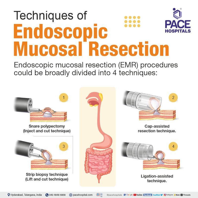 endoscopic mucosal resection technique types | endoscopic mucosal resection cost | endoscopic mucosal resection near me | endoscopic mucosal resection procedure in Hyderabad, India | endoscopic mucosal resection colon polyps, barrett's esophagus