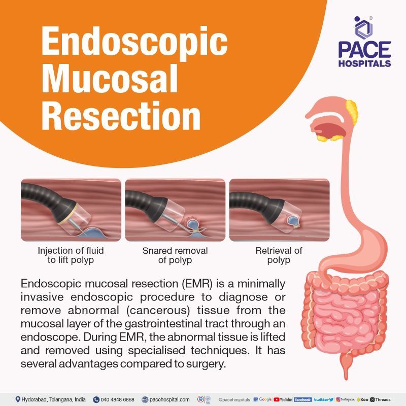 Endoscopic Mucosal Resection near me | what is EMR procedure | Endoscopic Mucosal Resection in hyderabad telangana | Endoscopic Mucosal Resection cost in India | endoscopic mucosal resection doctors