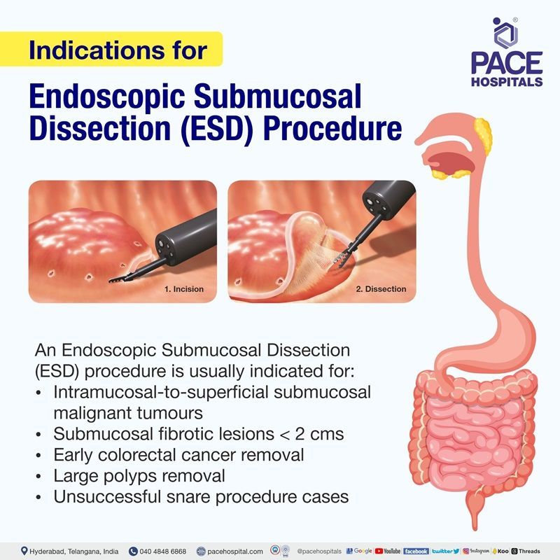 indications for endoscopic submucosal dissection procedure | ESD procedure in Hyderabad | endoscopic submucosal dissection esophagus | ESD procedure cost in India