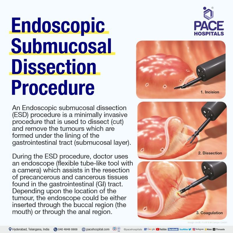 endoscopic submucosal dissection near me | what is ESD procedure | endoscopic submucosal dissection procedure in hyderabad telangana | endoscopic submucosal dissection cost in India