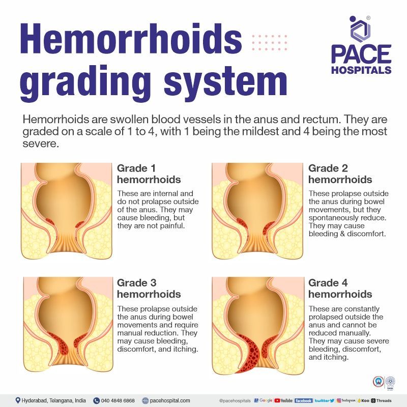 types of piles | non surgical treatment for grade 1 piles | grade 2 & grade 3 piles treatment | laser treatment for grade 4 piles