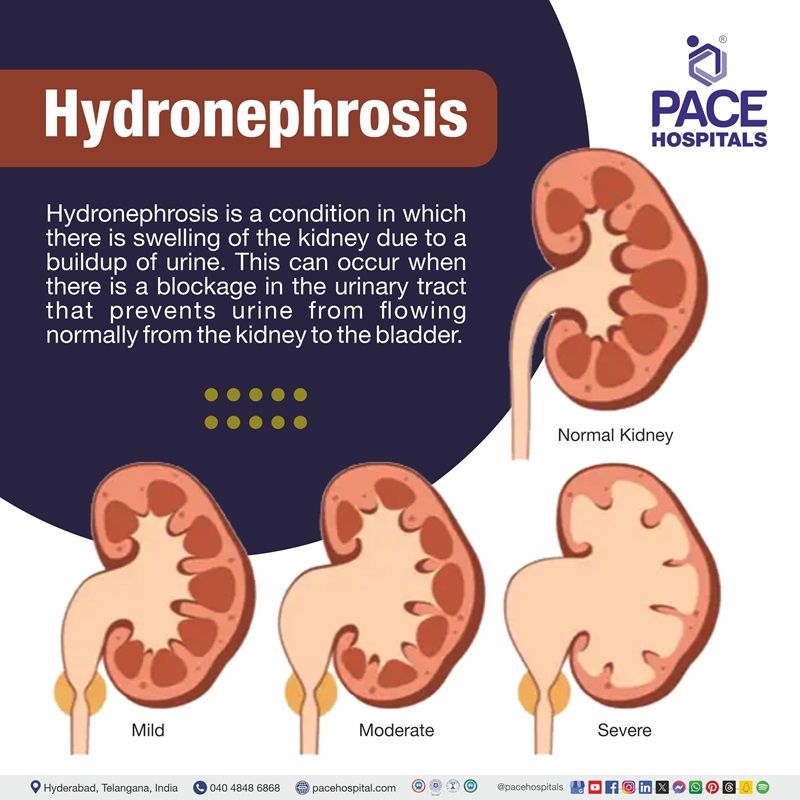 hydronephrosis meaning | kidney hydronephrosis | mild hydronephrosis | bilateral hydronephrosis | hydronephrosis grading | moderate hydronephrosis | gross hydronephrosis