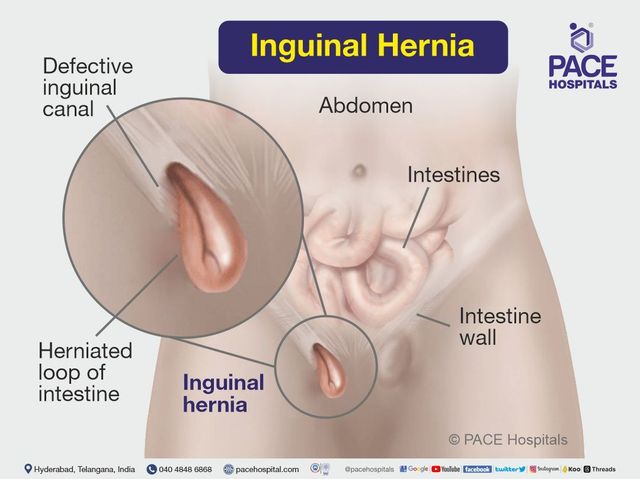 Inguinal hernia, Diagnosis, Treatment