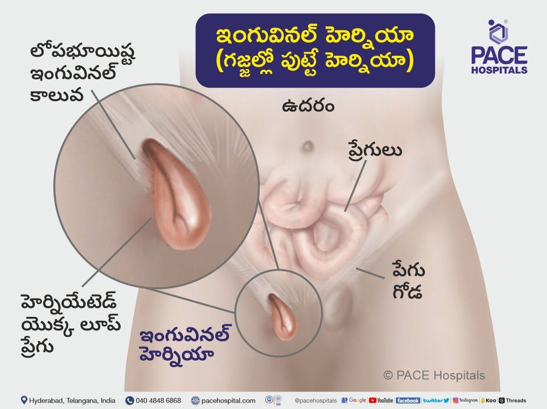 inguinal hernia in telugu | inguinal hernia anatomy in telugu | hernia inguinal meaning in telugu | direct and indirect inguinal hernia treatment in hyderabad india