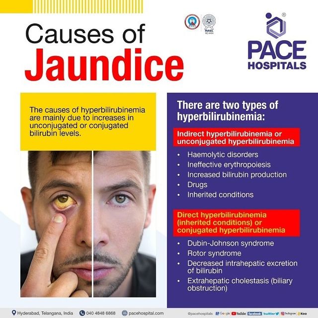 jaundiced eyes in adults