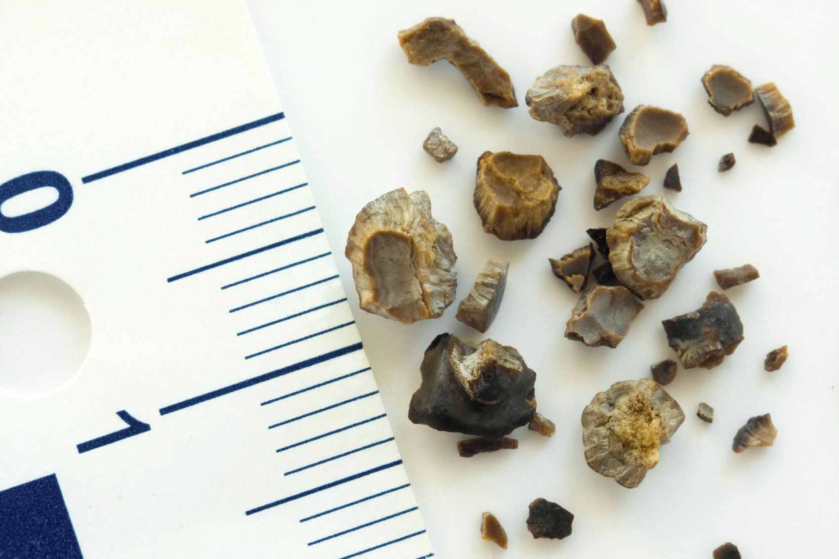 What are the causes for Kidney Stone Causes?
