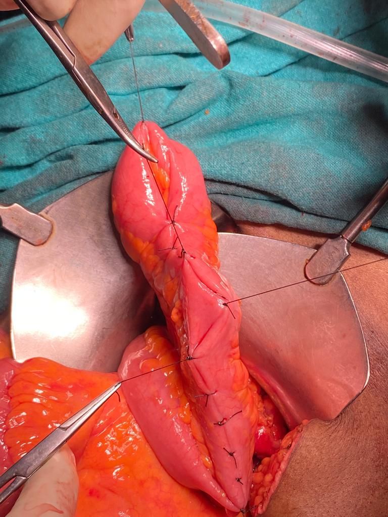 Laparoscopic total proctocolectomy and ileal pouch surgery at PACE Hospitals, Hyderabad