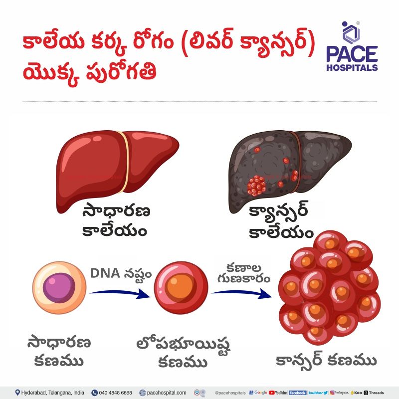 liver cancer in telugu | liver cancer development in telugu | liver cancer meaning in telugu 