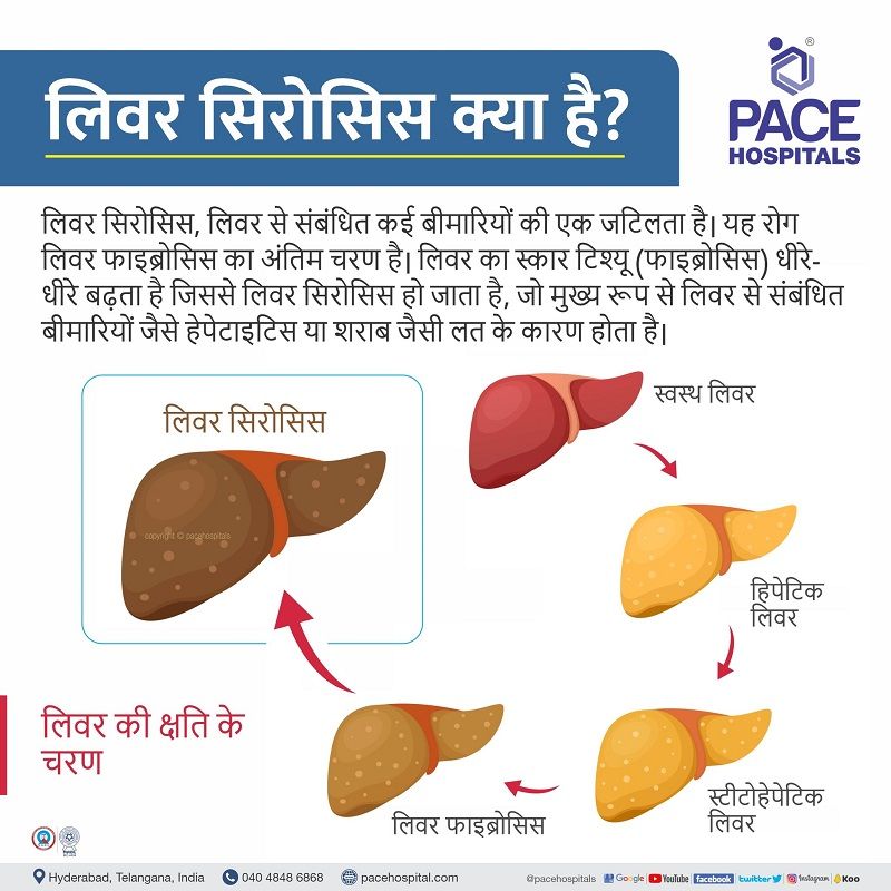 liver cirrhosis introduction in hindi | cirrhosis meaning in hindi | primary biliary cirrhosis in hindi | cirrhosis in hindi meaning