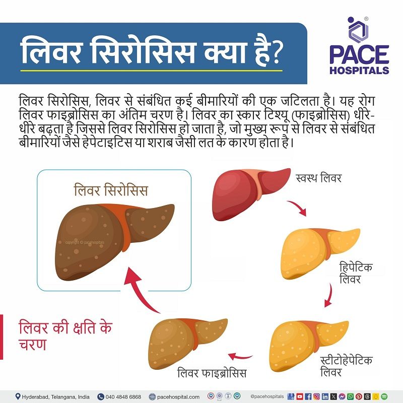 liver cirrhosis introduction in hindi | cirrhosis meaning in hindi | primary biliary cirrhosis in hindi | cirrhosis in hindi meaning