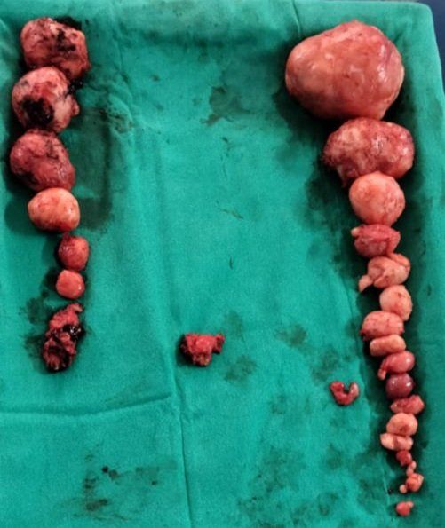 open myomectomy and laparoscopic myomectomy for uterine fibroids weighing over 2 Kg