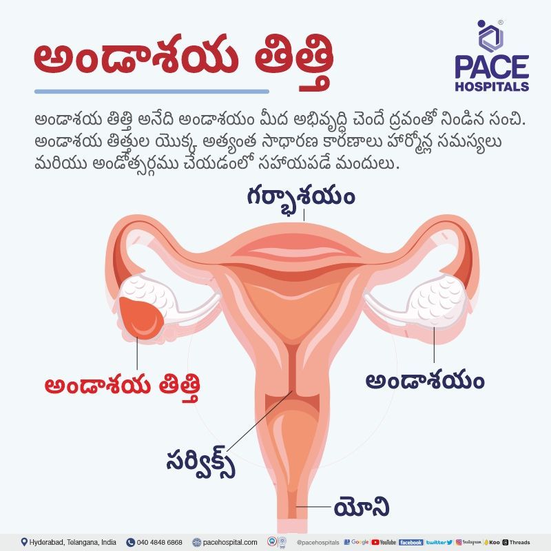 ovarian cyst meaning in telugu language | ovarian cyst in telugu language | ovary cyst in telugu language | about ovarian cyst in telugu | ovarian cyst telugu translation