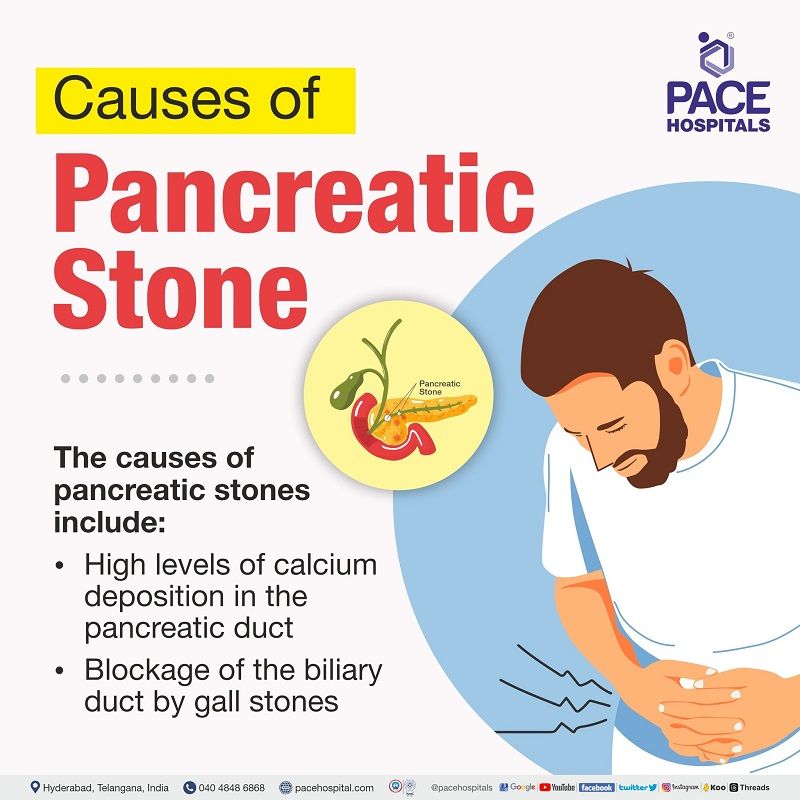 pancreatic stones causes | pancreatolithiasis causes | pancreatic calculi causes | pancreatic duct stones causes