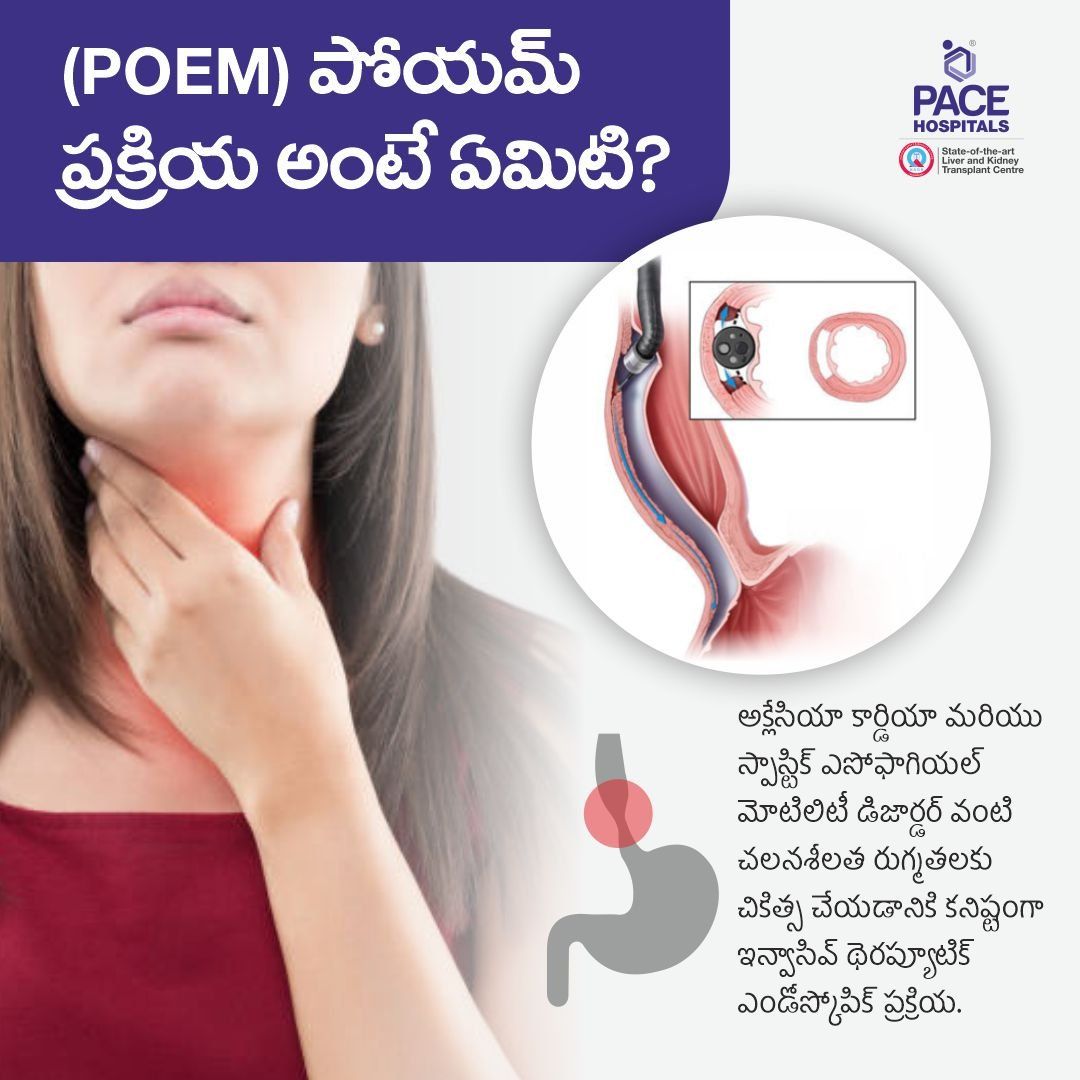 అకలేషియా కార్డియా చికిత్స కోసం POEM శస్త్రచికిత్స POEM Procedure