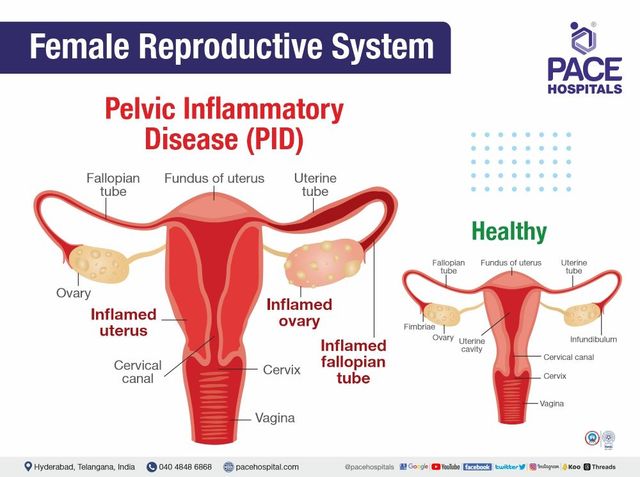 Pelvic inflammatory disease (PID) Gone after using Shisheherbal PID full  one month treatment This is indeed a beautiful way to start the…