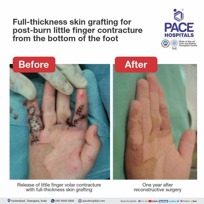 Post burn contracture finger surgery | post burn contracture hand