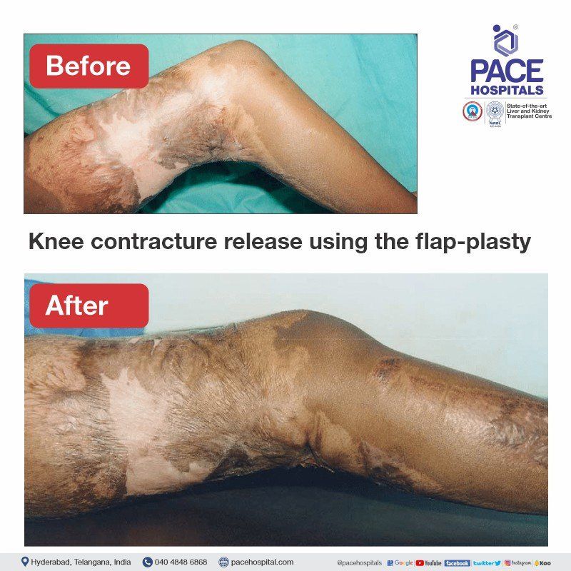 Post burn contracture knee surgery