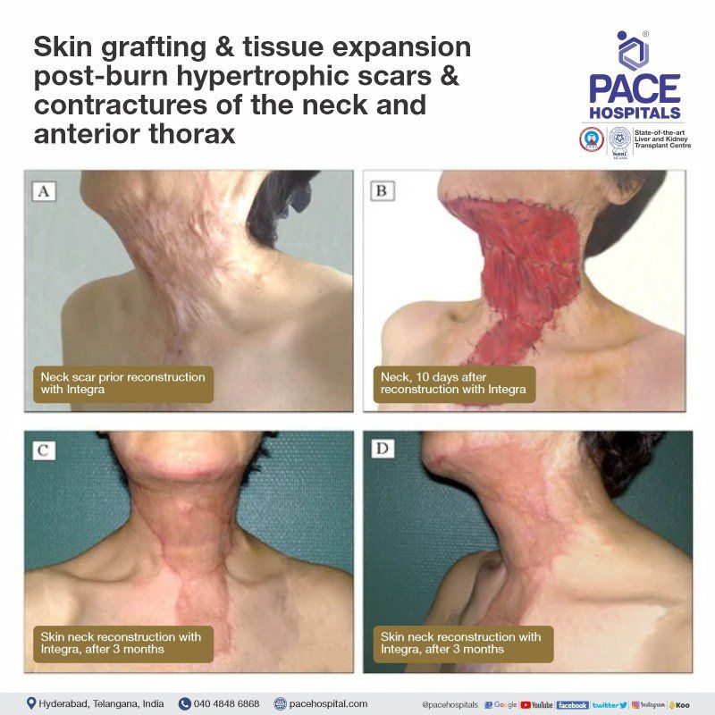 Post burn contracture neck surgery