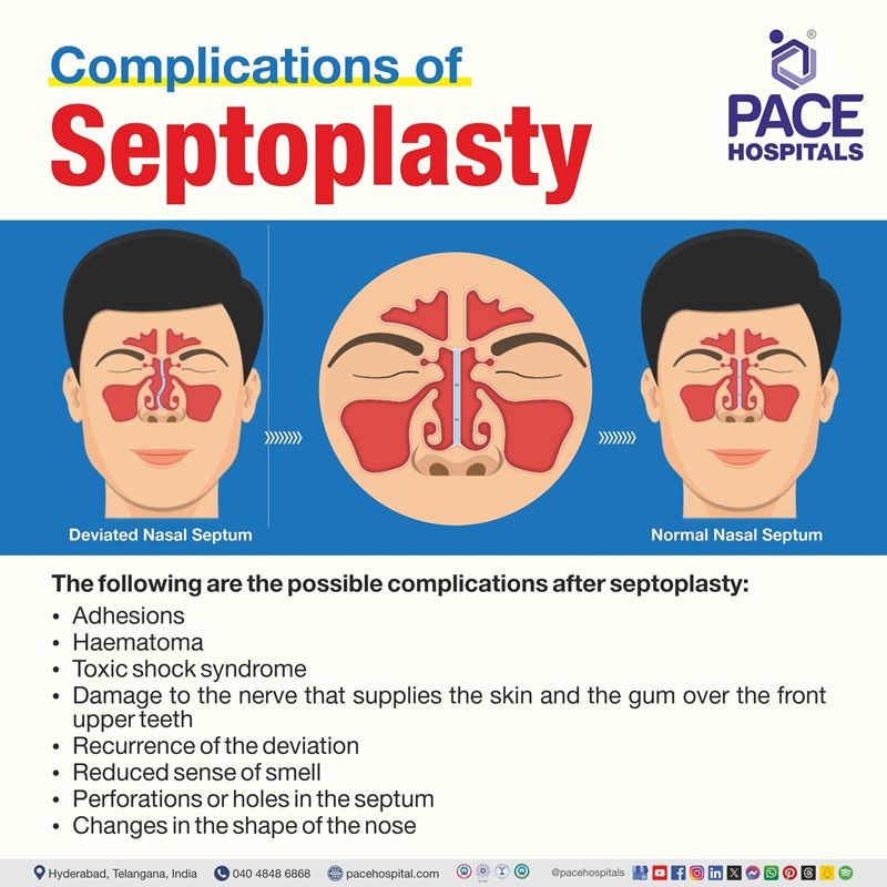 septoplasty complications | complications after septoplasty | complications of septoplasty surgery | complications post septoplasty | septoplasty complicated