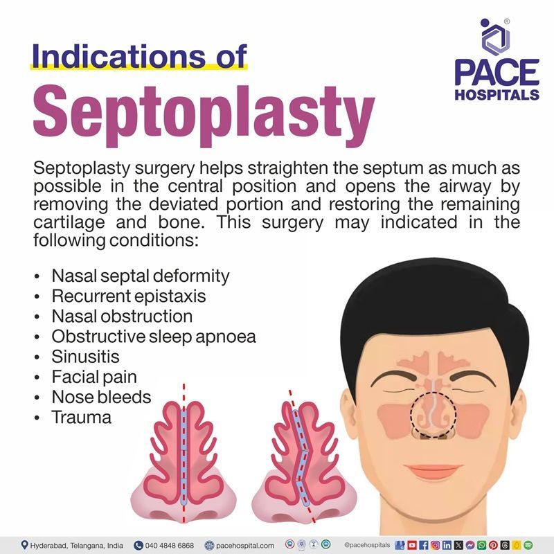 septoplasty indications | septoplasty and fess surgery in Hyderabad, India | indication of septoplasty surgery