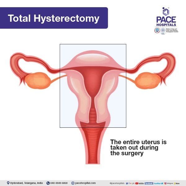 Total Laparoscopic Hysterectomy in Hyderabad | Robotic Hysterectomy in Hyderabad