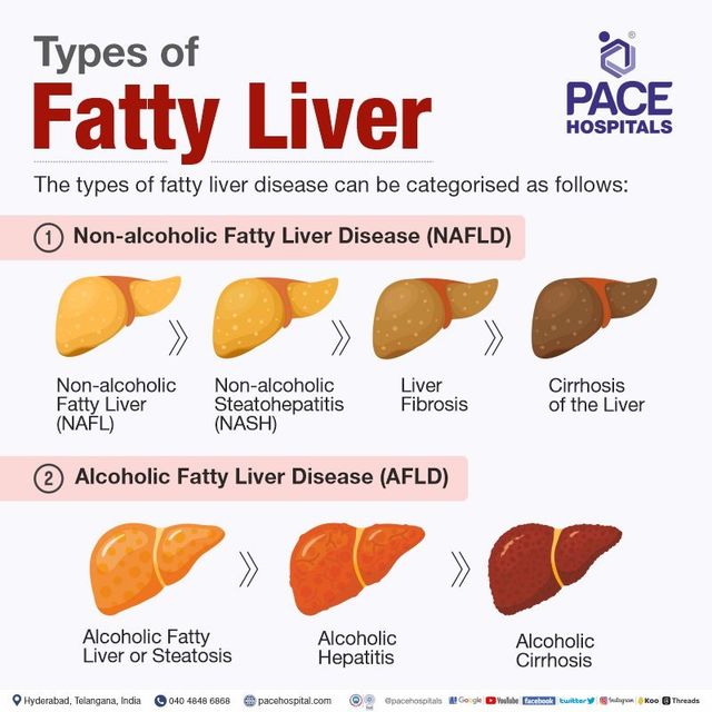 https://lirp.cdn-website.com/69c0b277/dms3rep/multi/opt/types%2Bof%2Bfatty%2Bliver%2Bdisease-640w.jpg