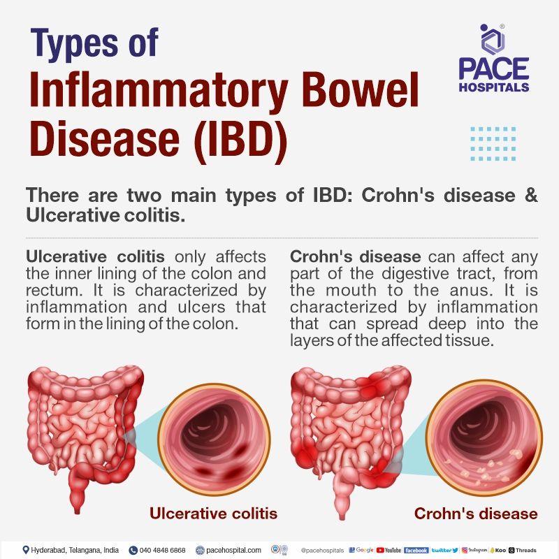 types of inflammatory bowel disease | types of IBD | Crohn's disease and ulcerative colitis