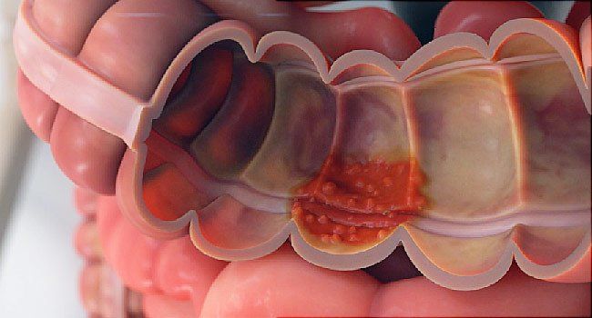 Ulcerative colitis: Video, Anatomy & Definition