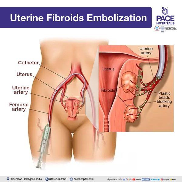 Uterine Fibroid Embolization in Hyderabad | Uterine Artery Embolization | Uterine Fibroids Treatment