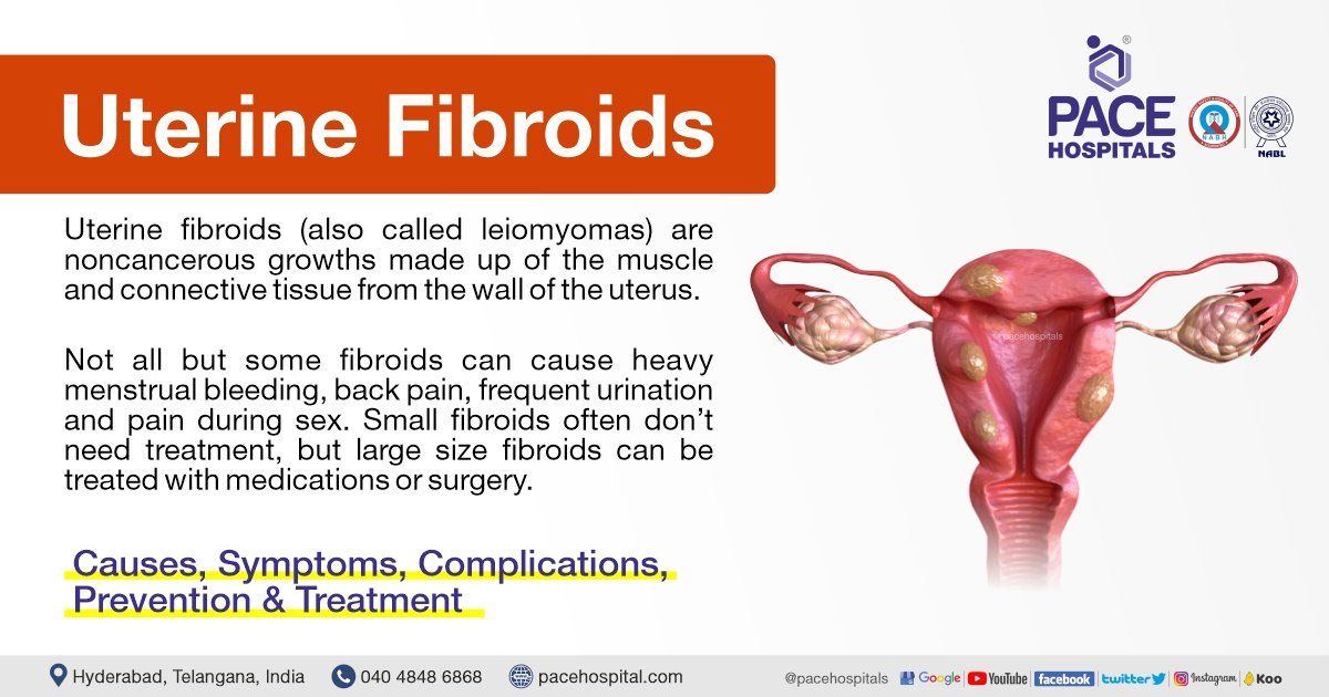 How Do Fibroids Cause Infertility?: Women's Pelvic Surgery of - santos ...