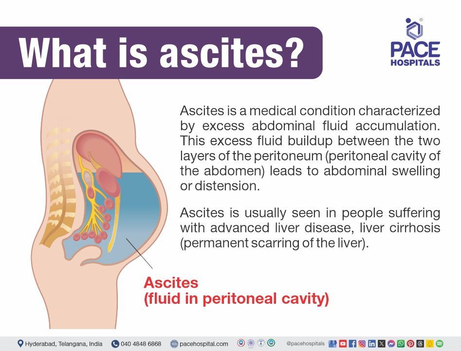ascites meaning | what is ascites | mild ascites | ascites definition | abdominal ascites